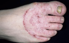 Seene ilmumise põhjused jalgadele