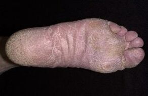 Seente tunnused ja sümptomid jalgadel