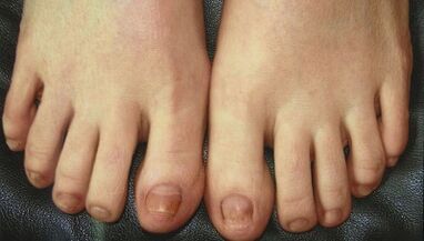 Küünte seene arendamise etapid