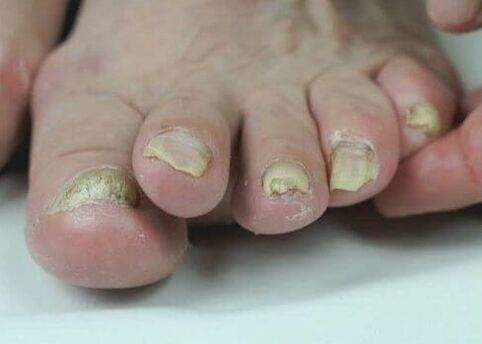 küüneseene ravi ravimitega