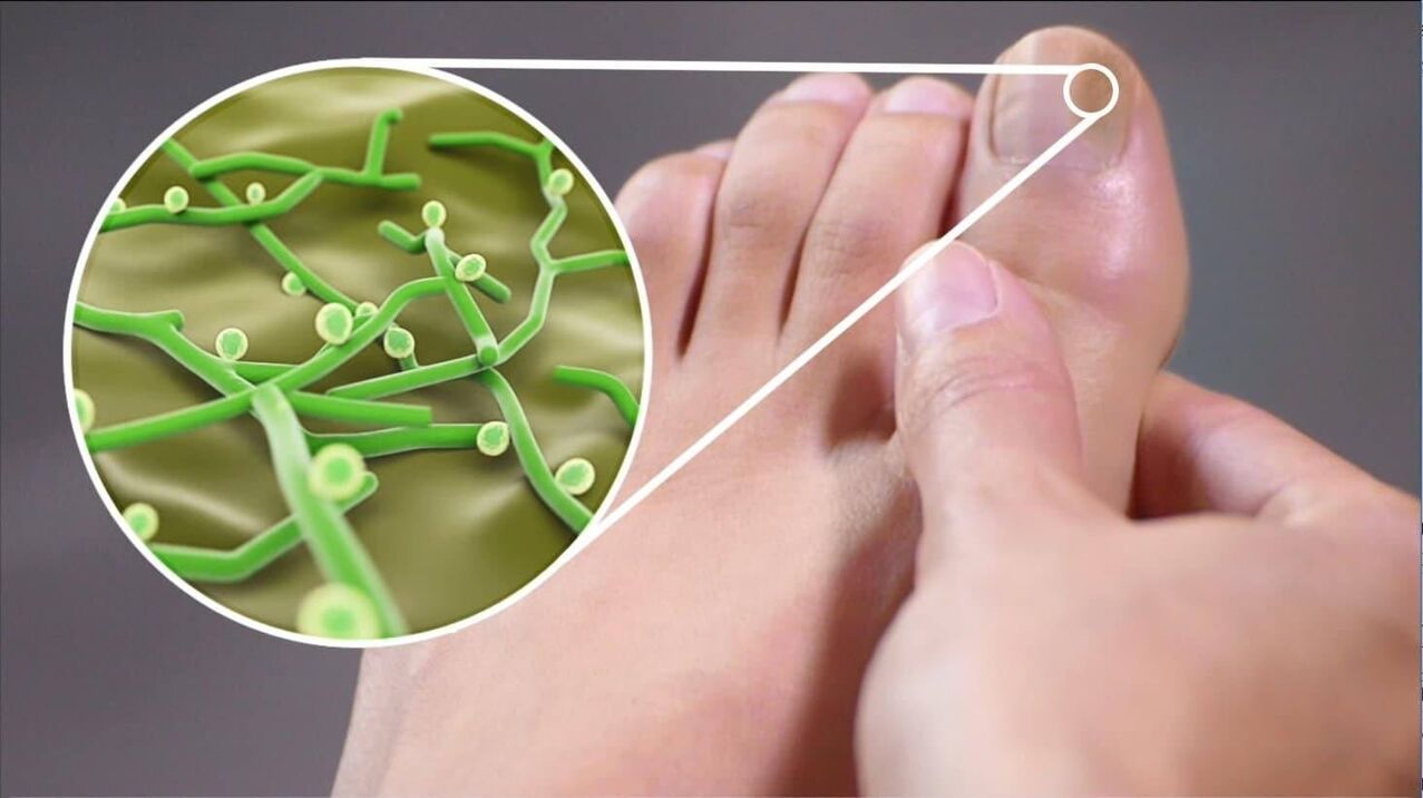 varbaküüneseene patogeenid