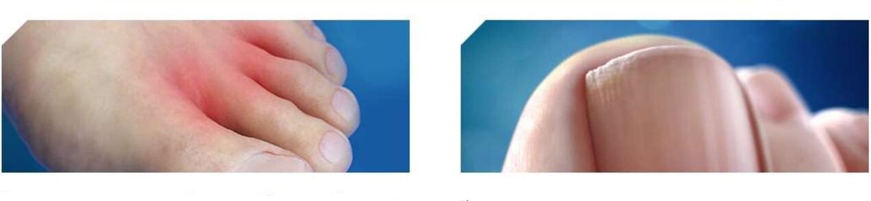 jalaseene algstaadium